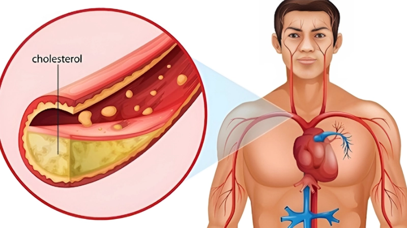 Làm thế nào để kiểm soát cholesterol hiệu quả?
