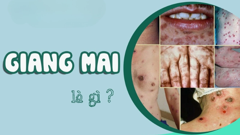 Giang mai là bệnh gì? Bản chất và nguyên nhân gây bệnh