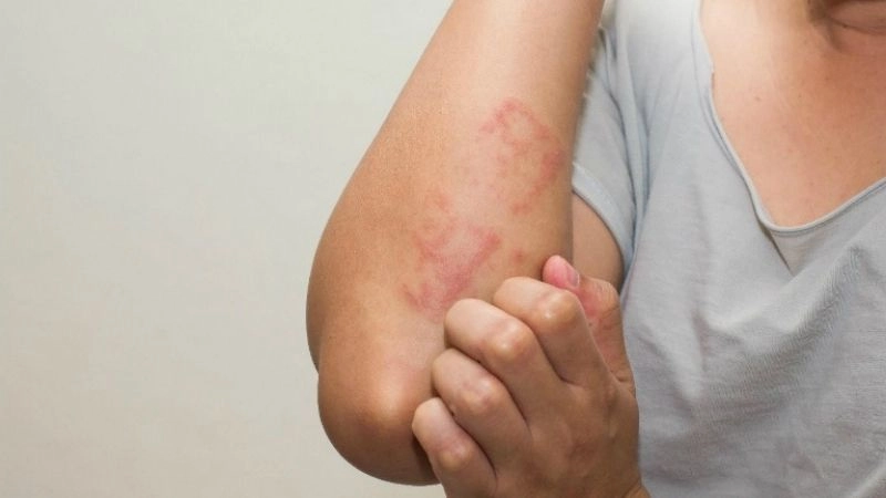 Mẹo dân gian chữa dị ứng 