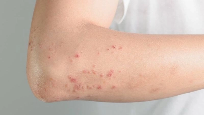 Nguyên nhân dẫn đến sởi ở người lớn và trẻ nhỏ