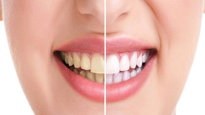 Nguyên nhân khiến răng xỉn màu ngày càng phổ biến