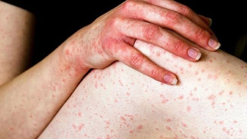 Nguyên nhân dẫn đến viêm da cơ địa 