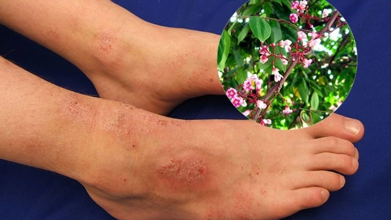 Bí kíp dân gian chữa viêm da cơ địa giảm ngứa hiệu quả