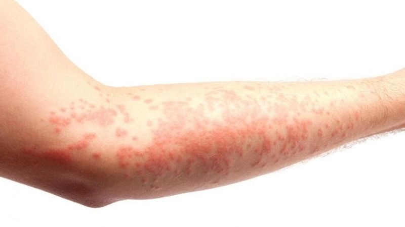 Nguyên nhân dẫn đến nổi mề đay cần hiểu rõ 