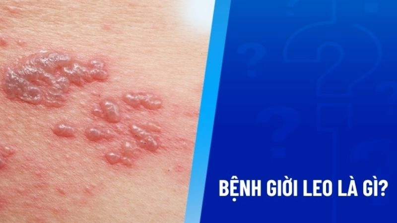 Giời leo là gì và cách nhận biết chính xác