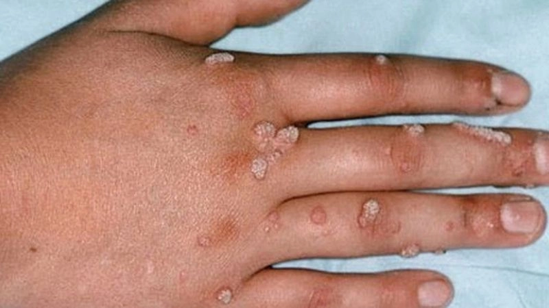 Nguyên nhân dẫn đến mụn cóc thường gặp