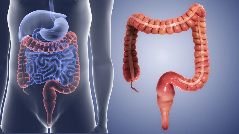 Nguyên nhân gây viêm đại tràng dễ bị bỏ qua