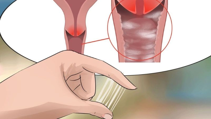 Nấm phụ khoa hay còn gọi là nấm âm đạo