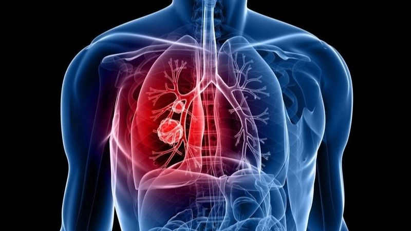 Nguyên nhân dẫn đến viêm phổi phổ biến 
