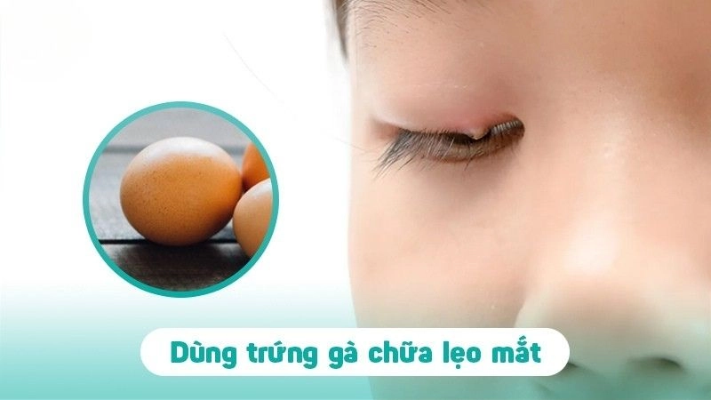 Dân gian chữa lẹo mắt không cần thuốc tây