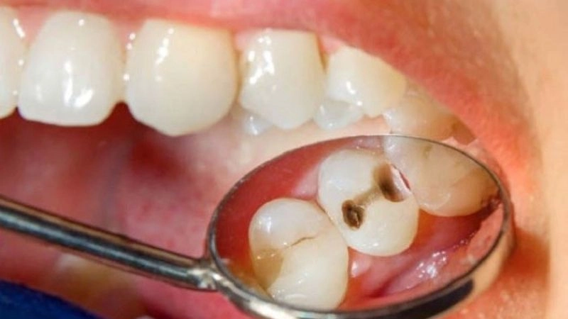 Nguyên nhân nào dẫn đến sâu răng phổ biến nhất
