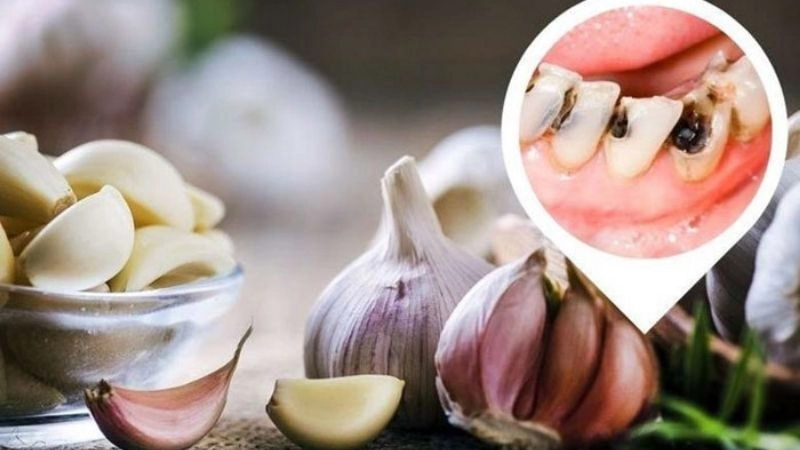 Mẹo chữa sâu răng dân gian giúp giảm ê buốt hiệu quả