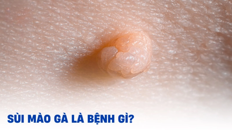 Bệnh sùi mào gà là gì? Tổng quan về căn bệnh dễ lây lan