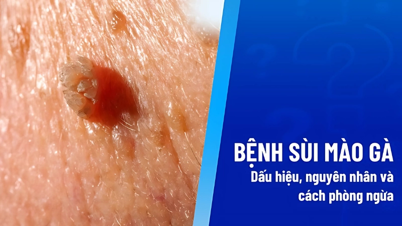 Biểu hiện của bệnh sùi mào gà theo từng giai đoạn
