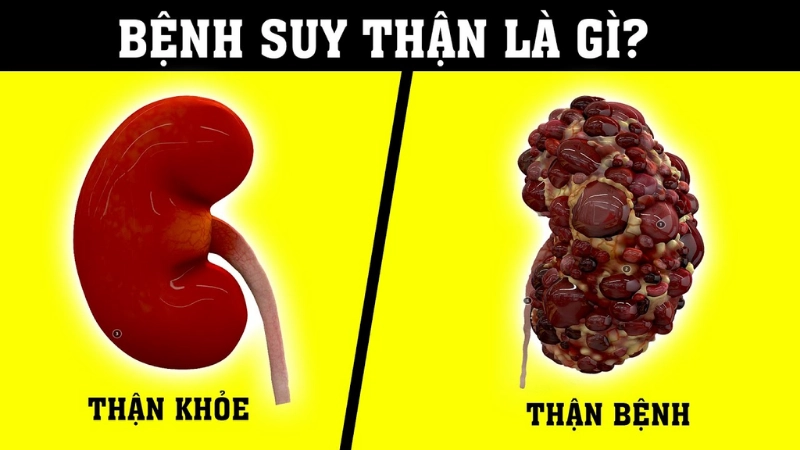 Dấu hiệu nhận biết suy thận