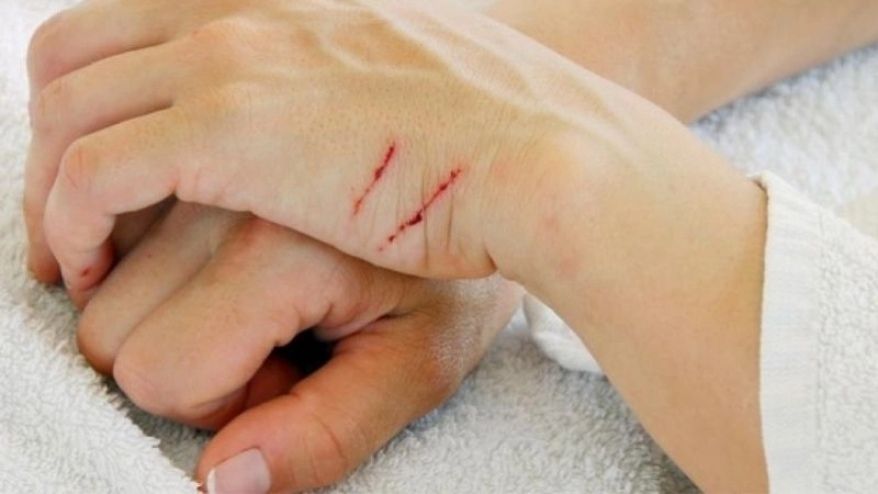 Triệu chứng khi bị mèo cào thường gặp nhất