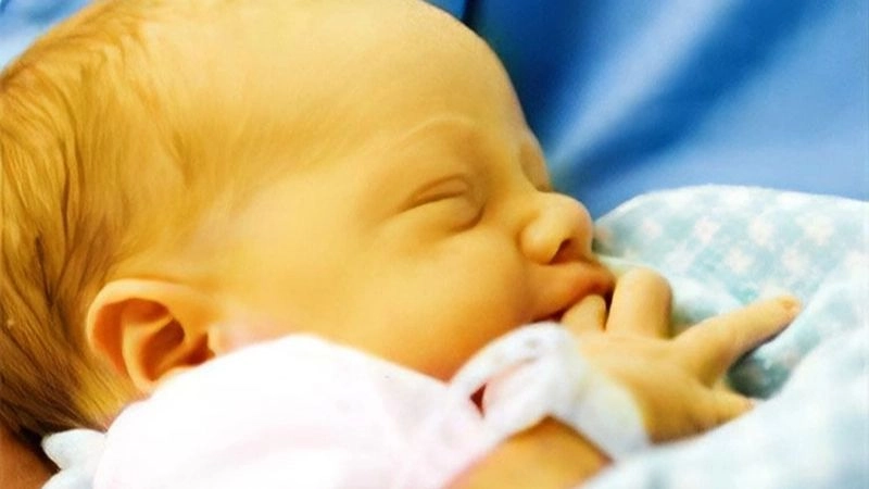 Vàng da bệnh lý là tình trạng nồng độ bilirubin trong máu của trẻ tăng cao
