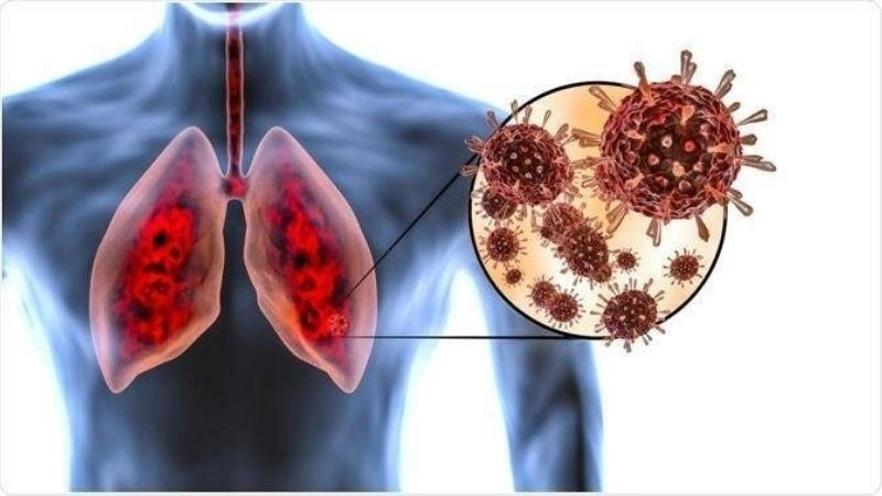 Nguyên nhân gây bệnh viêm phổi phổ biến nhất
