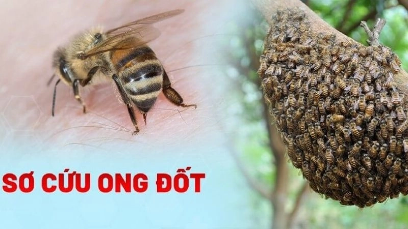 Cách sơ cứu khi bị ong đốt đúng chuẩn y tế