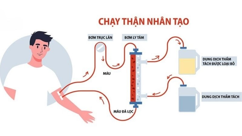 Lọc máu nhân tạo là việc sử dụng máy ở bên ngoài cơ thể để làm sạch các chất thải