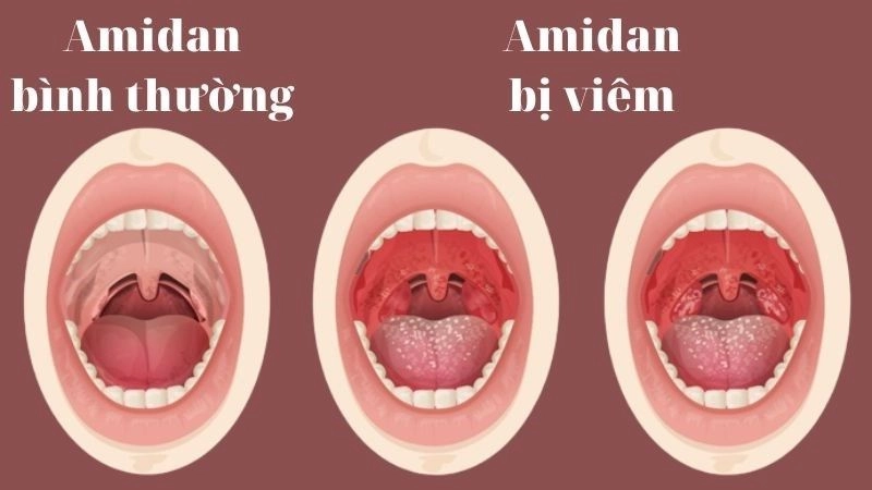 Nguyên nhân bị viêm amidan thường gặp nhất