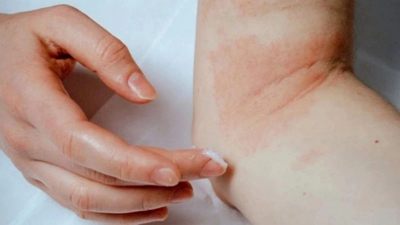Cách xử lý đúng khi bị sứa cắn giúp giảm đau đớn