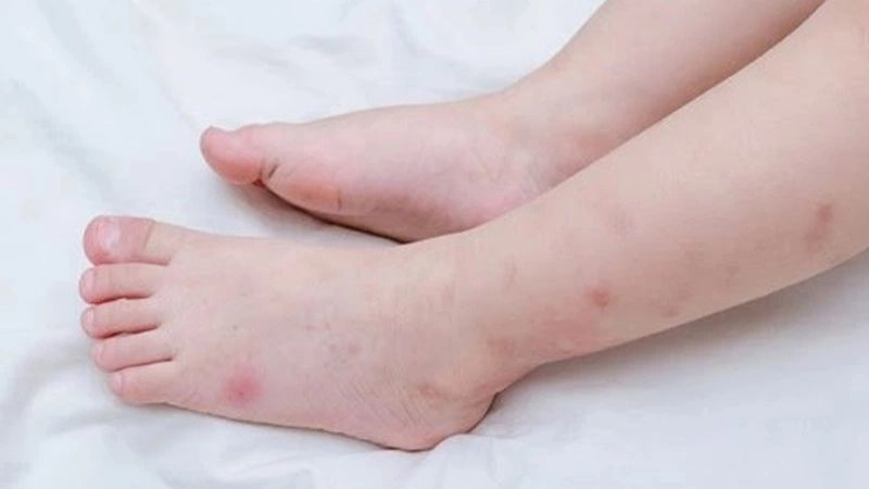 Khi bị ve cắn phải làm sao để an toàn và không để lại biến chứng