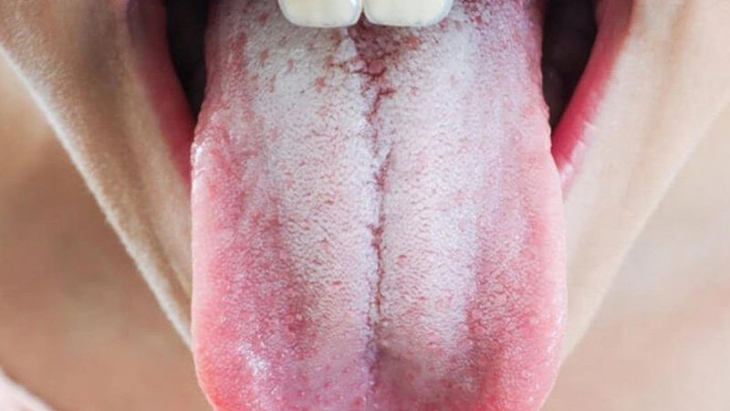 Nguyên nhân dẫn đến tình trạng lưỡi màu trắng
