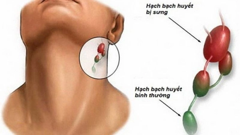Hạch có chức năng sản xuất và lưu trữ các tế bào bạch cầu