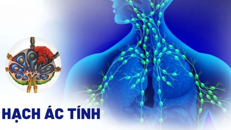 Hạch ác tính là hạch sưng do bệnh lý ác tính, thường là các loại ung thư 