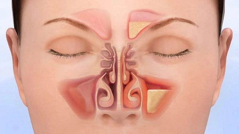 Viêm xoang là một căn bệnh xảy ra khi vùng niêm mạc lót trong các xoang mũi bị phù nề và tắc nghẽn