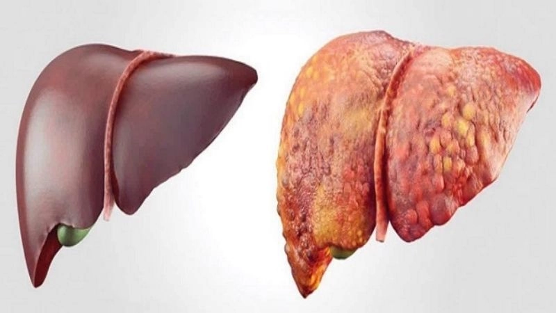 Nguyên nhân dẫn đến mắt bị vàng cần lưu ý