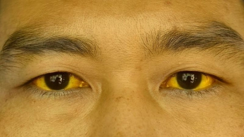 Các tình trạng gắn với vàng mắt