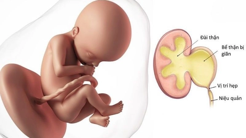 Hiện tượng giãn bể thận thai nhi, hay còn được gọi là thận ứ nước, xảy ra ở khoảng 1% số trường hợp thai nhi