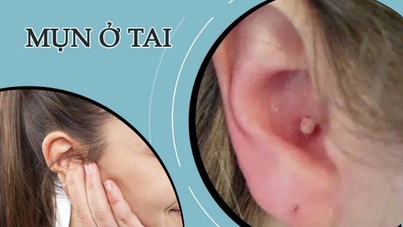 Nguyên nhân gây nên mụn mọc trong tai