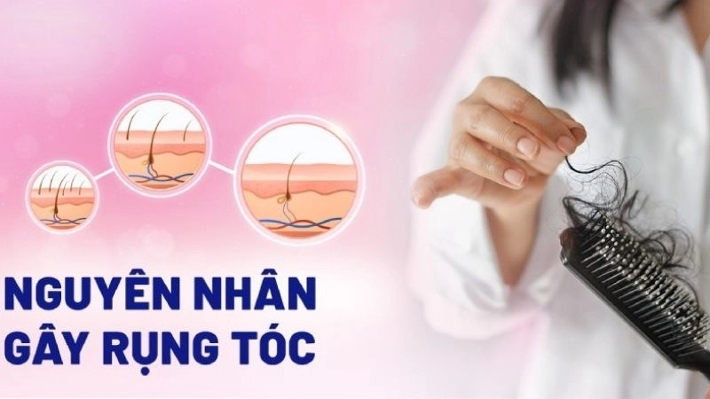 Nguyên nhân dẫn đến rụng tóc nhiều