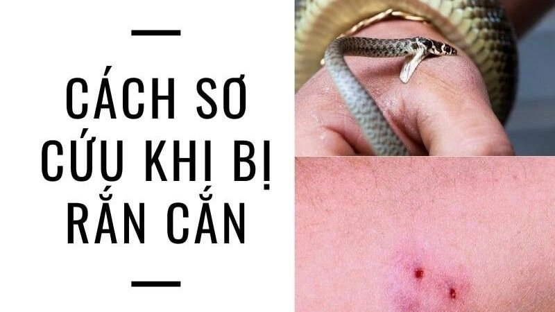Cách sơ cứu khi bị rắn cắn an toàn hiệu quả