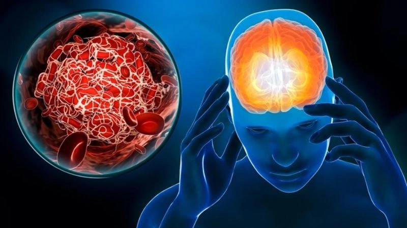 Đột quỵ (stroke) còn gọi là tai biến mạch máu não thường xảy ra đột ngột