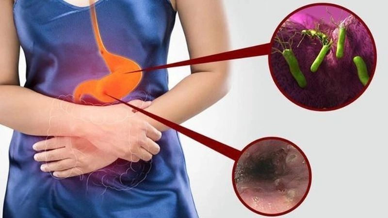 số lượng người Việt Nam bị nhiễm vi khuẩn dạ dày HP rất cao khoảng 60 đến 70% dân số