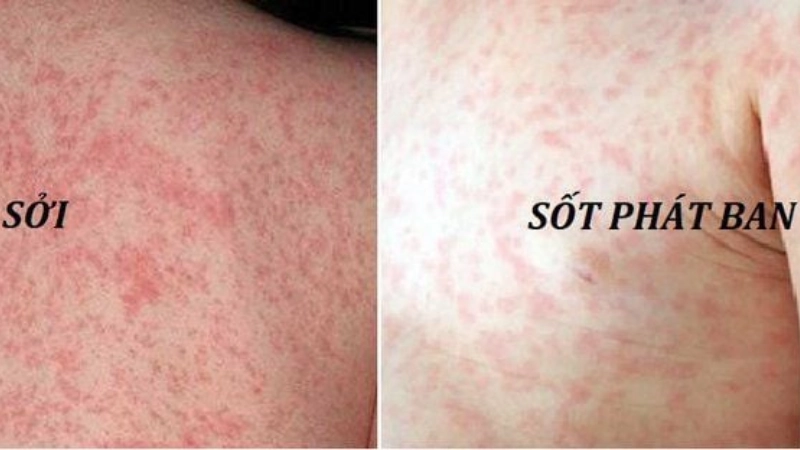 Triệu chứng điển hình của sởi và sốt phát ban