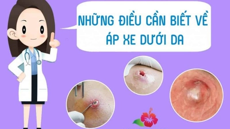 Nguyên nhân chính gây ra áp xe là do nhiễm trùng
