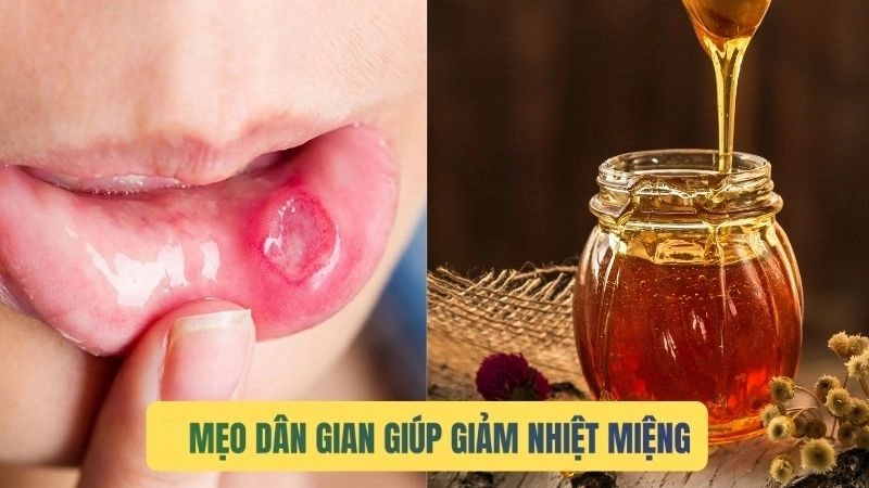 Cách dùng mẹo dân gian trị nhiệt miệng tại nhà