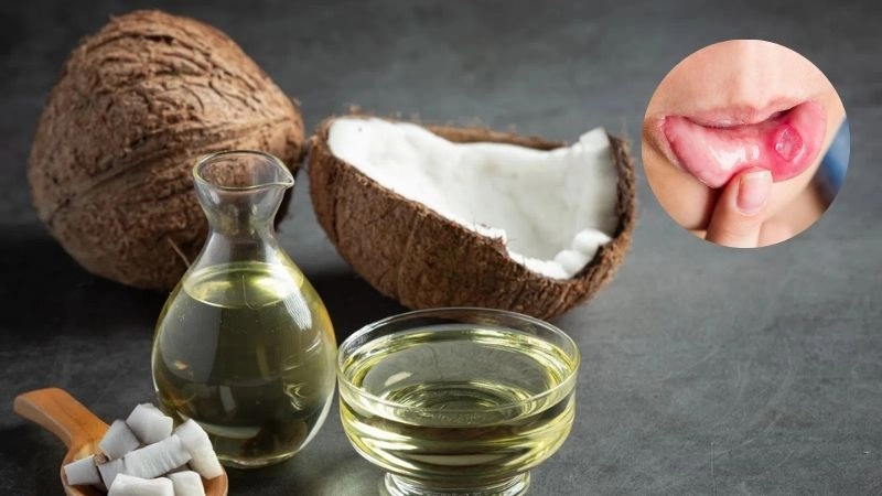 Mẹo dân gian trị nhiệt miệng giúp giảm đau rát