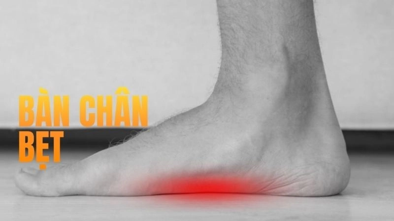 Bàn chân bẹt là tình trạng lòng bàn chân bằng phẳng, không có vùng lõm