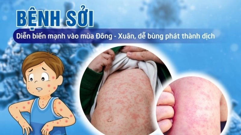 Tác hại của bệnh sởi đừng nên xem nhẹ